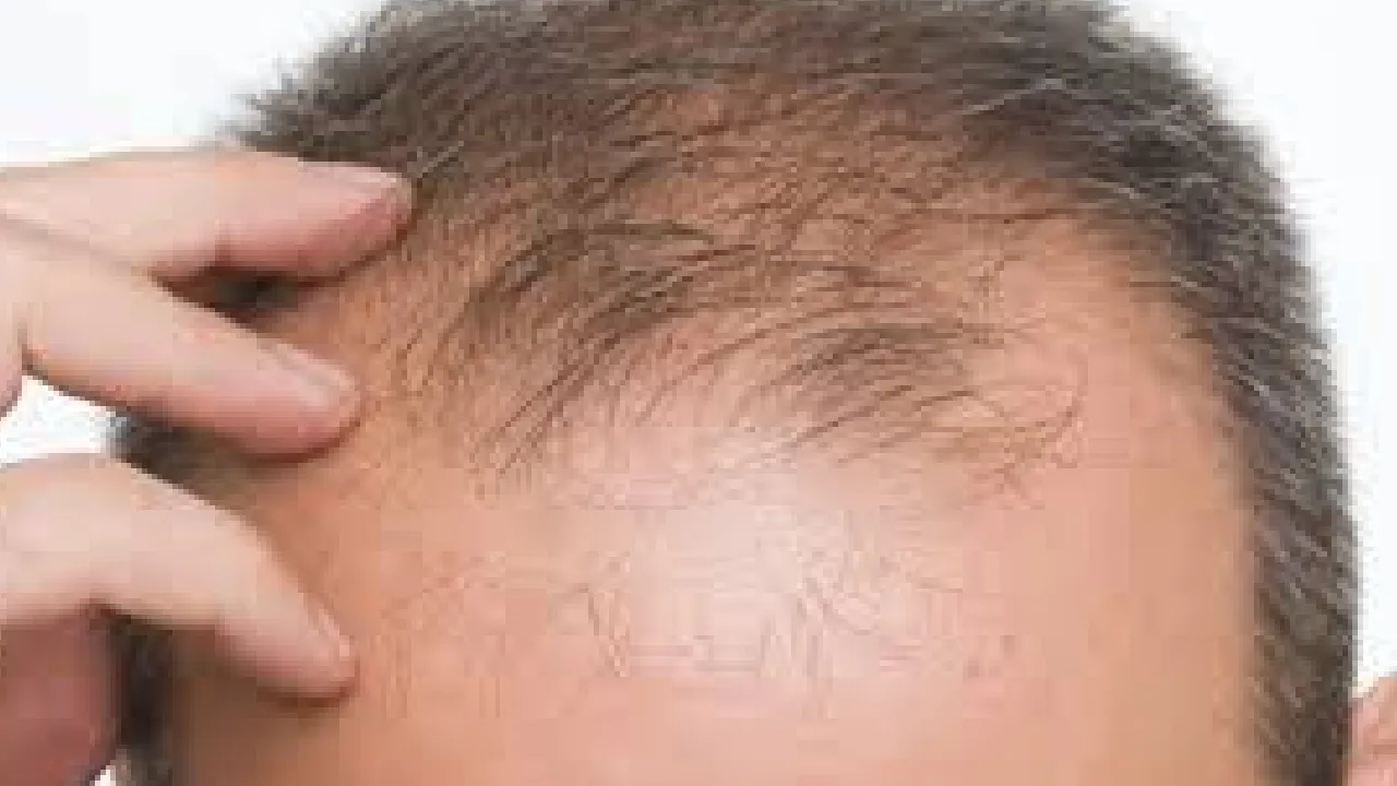 வழுக்கைக்கு முற்றுப்புள்ளி? – தலைமுடி உதிர்வை கட்டுப்படுத்தும் புதிய மருந்து வெற்றிப் பயணம்